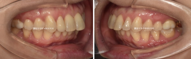 40대 인비절라인 라이트 가위교합? 관련 이미지 4