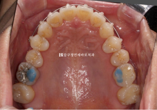 해외거주 중인데 교정 가능할까요? 4개월 단기 앞니교정 이야기 관련 이미지 6