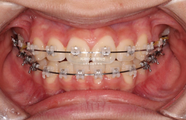 덧니 돌출입 발치교정 상악만 2개 편악 발치 클리피씨 입술부전증 치료 관련 이미지 7