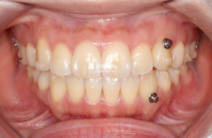 인비절라인 라이트 반대교합? 덧니 중심선 치간삭제 치료 관련 이미지 7