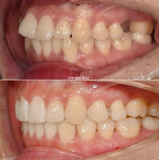 인비절라인 돌출입 발치교정 임플란트 없이 사랑니 대체 관련 이미지 24