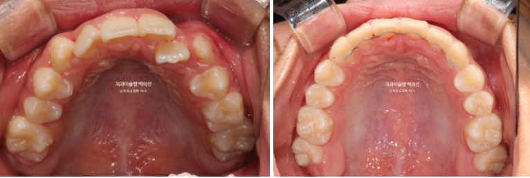 덧니 반대교합 과개교합 인비절라인 퍼스트 악궁확장 어린이 교정 치료 관련 이미지 20