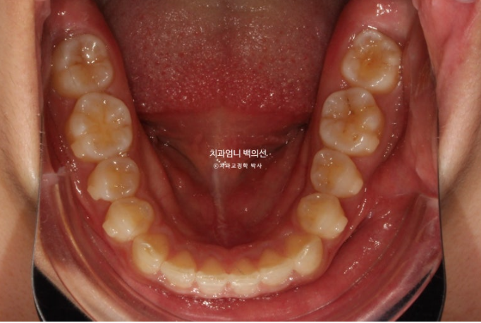 과개교합 옥니 거미스마일 교정 인비절라인 라이트 잇몸성형 후기 관련 이미지 10