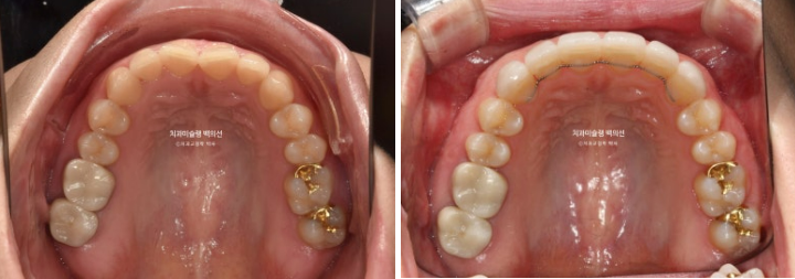 비발치 덧니 교정 인비절라인 과개교합 교정 무삭제 라미네이트 치료 후기 관련 이미지 18