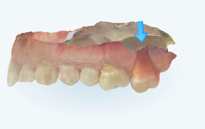 40대 인비절라인 라이트 앞니 돌출 과개교합 덧니 교정 후기 관련 이미지 4