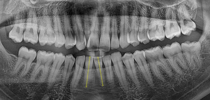 옥니 덧니 교정 왜소치 선천적 결손 3전치 무삭제 라미네이트 인비절라인 교정 관련 이미지 4