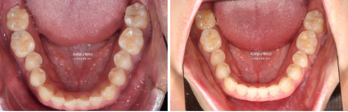MSE Palatal Expansion Invisalign Underbite Correction, Non-Surgical image 19