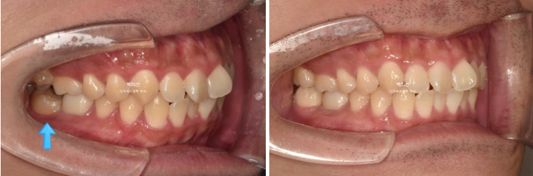 가위교합 나비치아 미니스크류 덧니 교정 인비절라인 라이트 관련 이미지 9