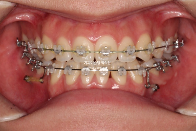 비수술 주걱턱 비대칭 발치 교정 결손치 반대교합 클리피씨 치료기간 1년 11개월 관련 이미지 7