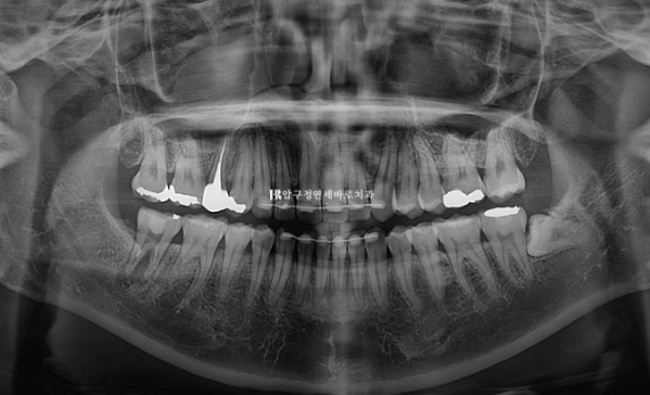웃을 때 잇몸이 보여요. 잇몸미소 거미스마일 교정하기 관련 이미지 14