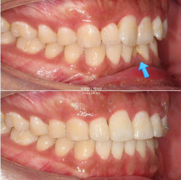앞니 부분교정 덧니 교정 블랙트라이앵글 부정교합 마모 시뮬레이션 치료기간 5개월 관련 이미지 15