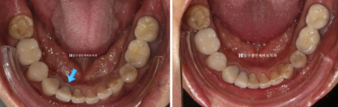 50대 라미네이트 삭제 없이 하는 법? 관련 이미지 7