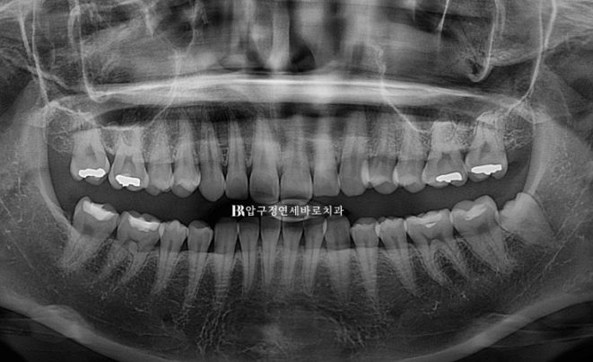 Does Invisalign Prevent Root Movement? Before-and-After Comparison of Extraction Treatment for Protruding Lips image 16