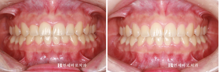 잇몸미소 거미스마일 원인에 따라 다른 치료방법? 관련 이미지 7