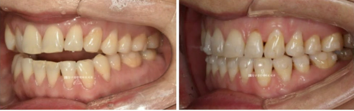 50대 인비절라인 함입 교정 후기 관련 이미지 7