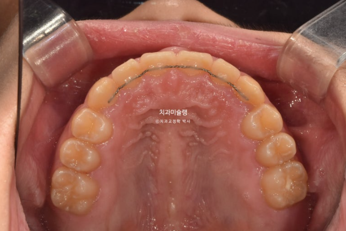 선천적 결손 잔존유치 과개교합 돌출입 인비절라인 퍼스트 어린이 투명교정 치료기간 관련 이미지 16