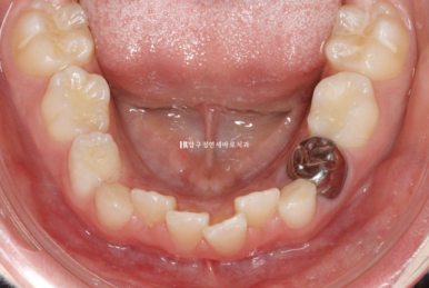 소아 투명교정 인비절라인 퍼스트 후기 기록 관련 이미지 3