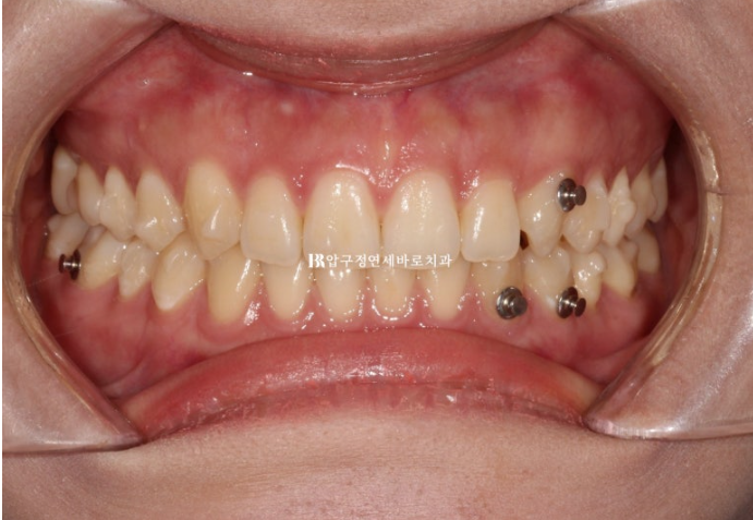 옥니 교정 인비절라인 라이트 옹니 덧니 치료기간 ? 관련 이미지 6