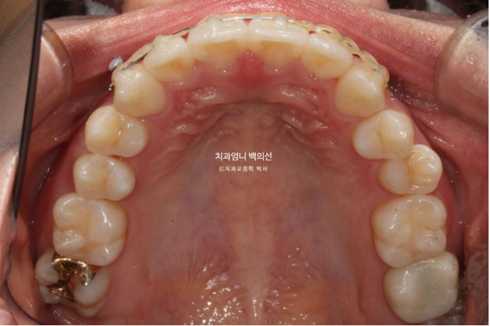 앞니 부분 교정 토끼이빨 덧니교정 ? 관련 이미지 9