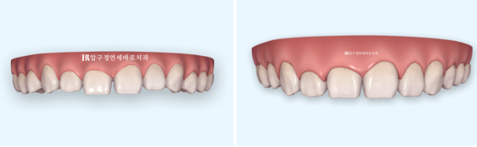 Four No-Prep Veneers for Dwarf Teeth and Conical Front Teeth image 3