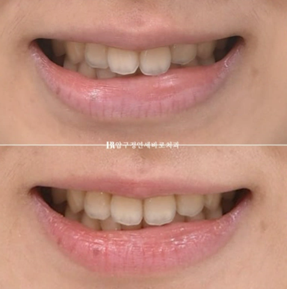 인비절라인 익스프레스 토끼이빨 앞니교정 ? 관련 이미지 16