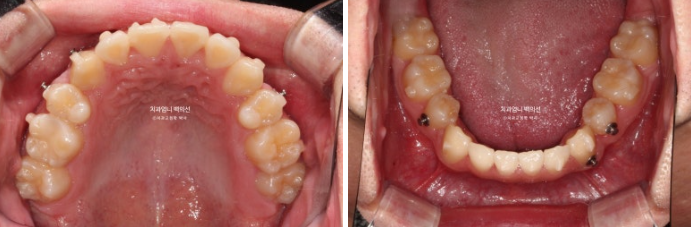 투명교정 인비절라인 덧니 교정 치료기간 알아보기 관련 이미지 7