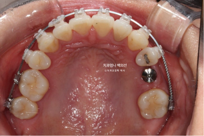 옥니 역교정 재교정 무턱 교정 치료기간 1년 10개월 관련 이미지 11