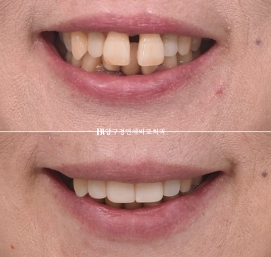 A 60s Patient’s Orthodontic Treatment Review | A Case Combining Partial Orthodontics for the Front Teeth After Periodontitis Treatment with No-Prep Veneers image 1