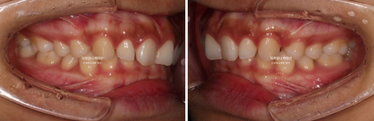 과개교합 옥니 거미스마일 교정 인비절라인 라이트 잇몸성형 후기 관련 이미지 3
