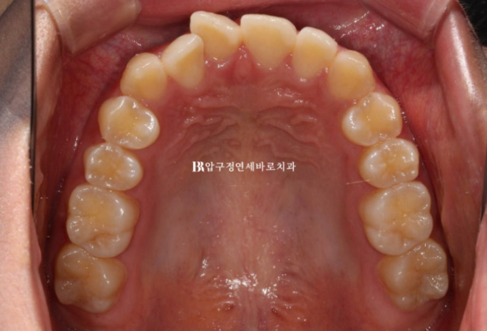 덧니도 부분교정이 가능할까요? 6개월 앞니 부분교정 실제 치료 사례 관련 이미지 3