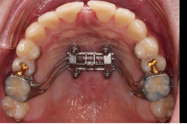 MSE Palatal Expansion Invisalign Underbite Correction, Non-Surgical image 7