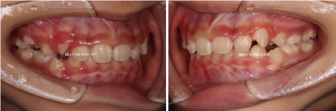 Pediatric Clear Aligners That Improved Both Deep Bite and Protruding Teeth image 7