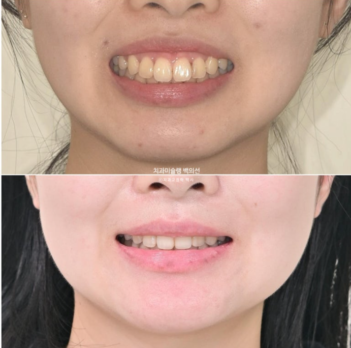 돌출입 인비절라인 발치교정 거미스마일 잇몸미소 잇몸돌출 입술부전증 무턱 재교정 관련 이미지 23