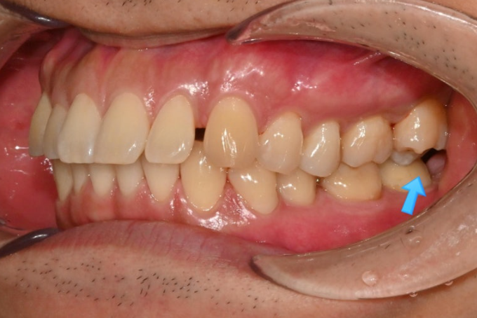 가위교합 벌어짐 중심선 과개교합 인비절라인 라이트 교정 관련 이미지 4