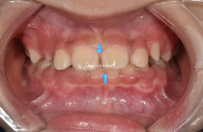Pediatric Clear Aligners That Improved Both Deep Bite and Protruding Teeth image 3