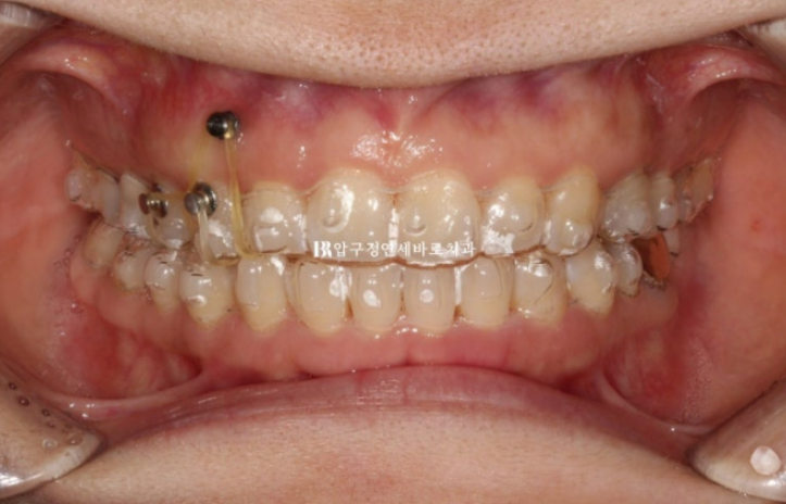 인비절라인 캔팅 교정 과개교합 교정 임플란트 재교정 관련 이미지 7