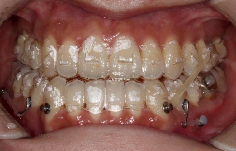 30대 비수술 비발치 주걱턱 부정교합 인비절라인 교정 관련 이미지 5