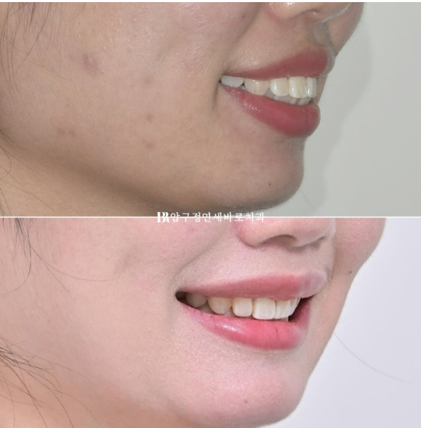 How Do the Buccal Corridors and Smile Line Change After Extraction Treatment for Protruding Teeth?|An Orthodontic Case That Also Improved Lip Incompetence image 16