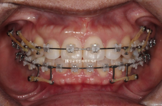 Orthodontic Retreatment in Your 40s | Improvement of Chin Retrusion and Lip Incompetence with Intrusion Orthodontics, Non-Extraction Orthodontic Treatment in Your 40s image 3