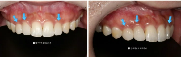왜소치 치료 잔존유치 무삭제 라미네이트 후기 관련 이미지 9