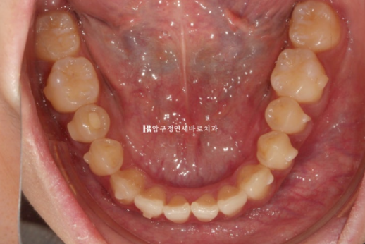 인비절라인 익스프레스 토끼이빨 교정 기간? 인비절라인 종류는? 관련 이미지 9