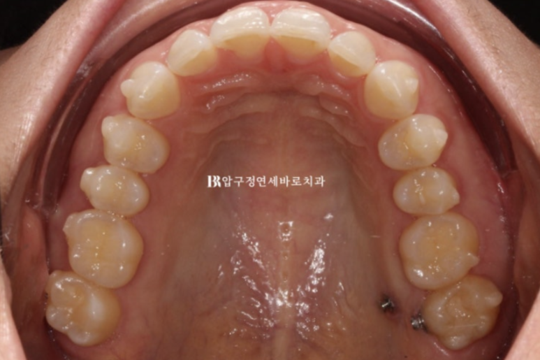 인비절라인 라이트 가위교합 치아 벌어짐 치료 관련 이미지 7