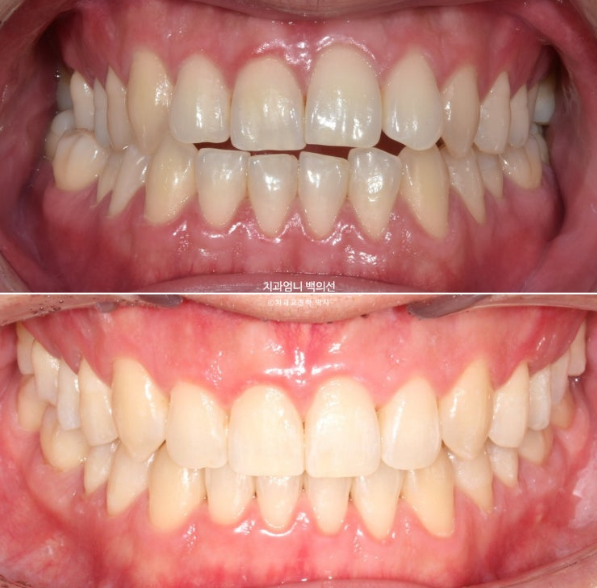 MSE Palatal Expansion Invisalign Underbite Correction, Non-Surgical image 20