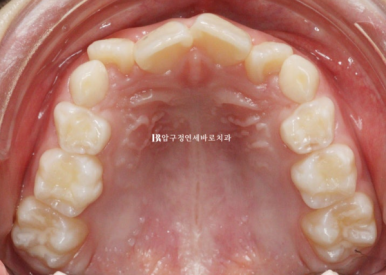 소아 투명교정 인비절라인 퍼스트 후기 기록 관련 이미지 2