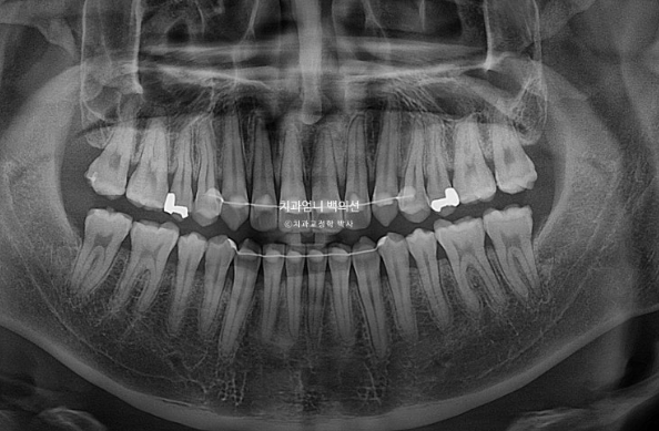 MSE Palatal Expansion Invisalign Underbite Correction, Non-Surgical image 26