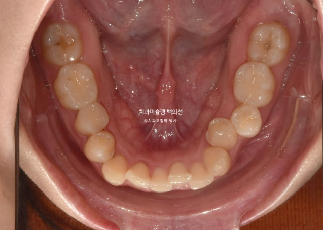 비발치 덧니 교정 인비절라인 과개교합 교정 무삭제 라미네이트 치료 후기 관련 이미지 5