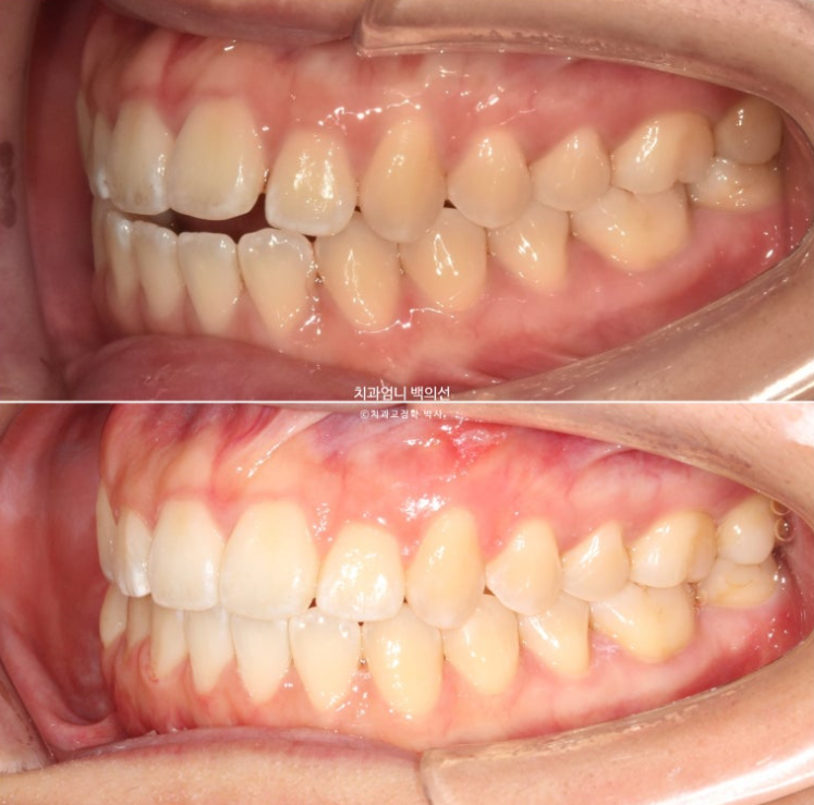앞니 단기 부분교정 재교정 개방교합 교정 후기 관련 이미지 14