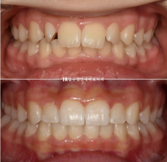 서울 인비절라인 덧니 교정 과개교합 후기 관련 이미지 9