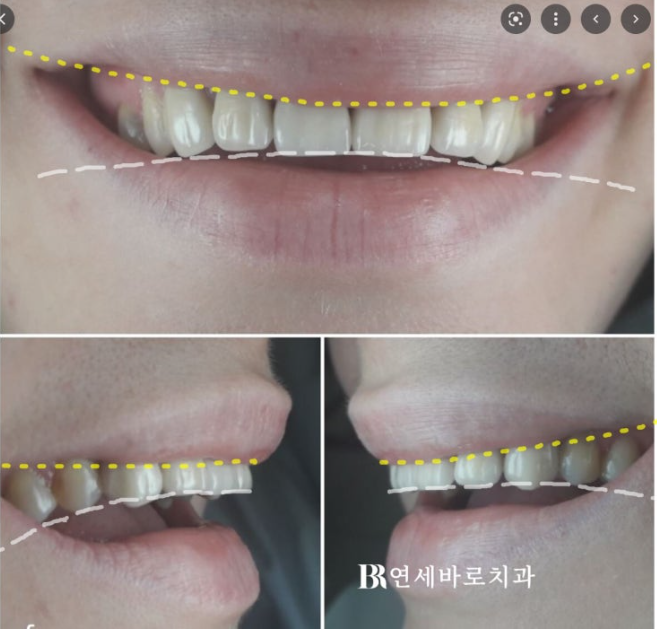 잇몸미소 거미스마일 원인에 따라 다른 치료방법? 관련 이미지 6