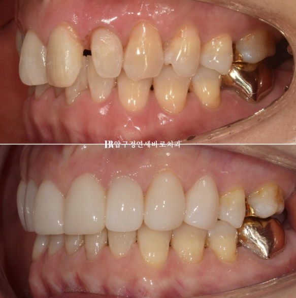 50s Invisalign Lite No-Prep Laminate Bunny Teeth image 15